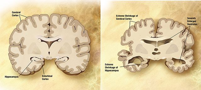 Atrofia Cortical Y Subcortical S Ntomas Causas Y Regiones